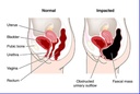 the-one-minute-miracle-oxy-colon-cleanse-6.jpg