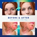 seborrheic-dermatitis-psoriasis-cream-an-4.jpg