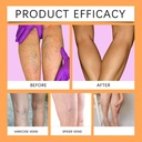 48-pcs-varicose-veins-treatment-for-legs-3.jpg