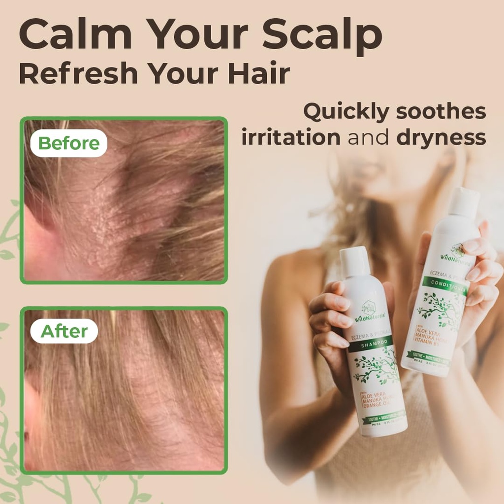 wild-naturals-eczema-and-psoriasis-treat-6.jpg
