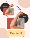 siya-ayurveda-psoriasis-treatment-oil-fo-3.jpg