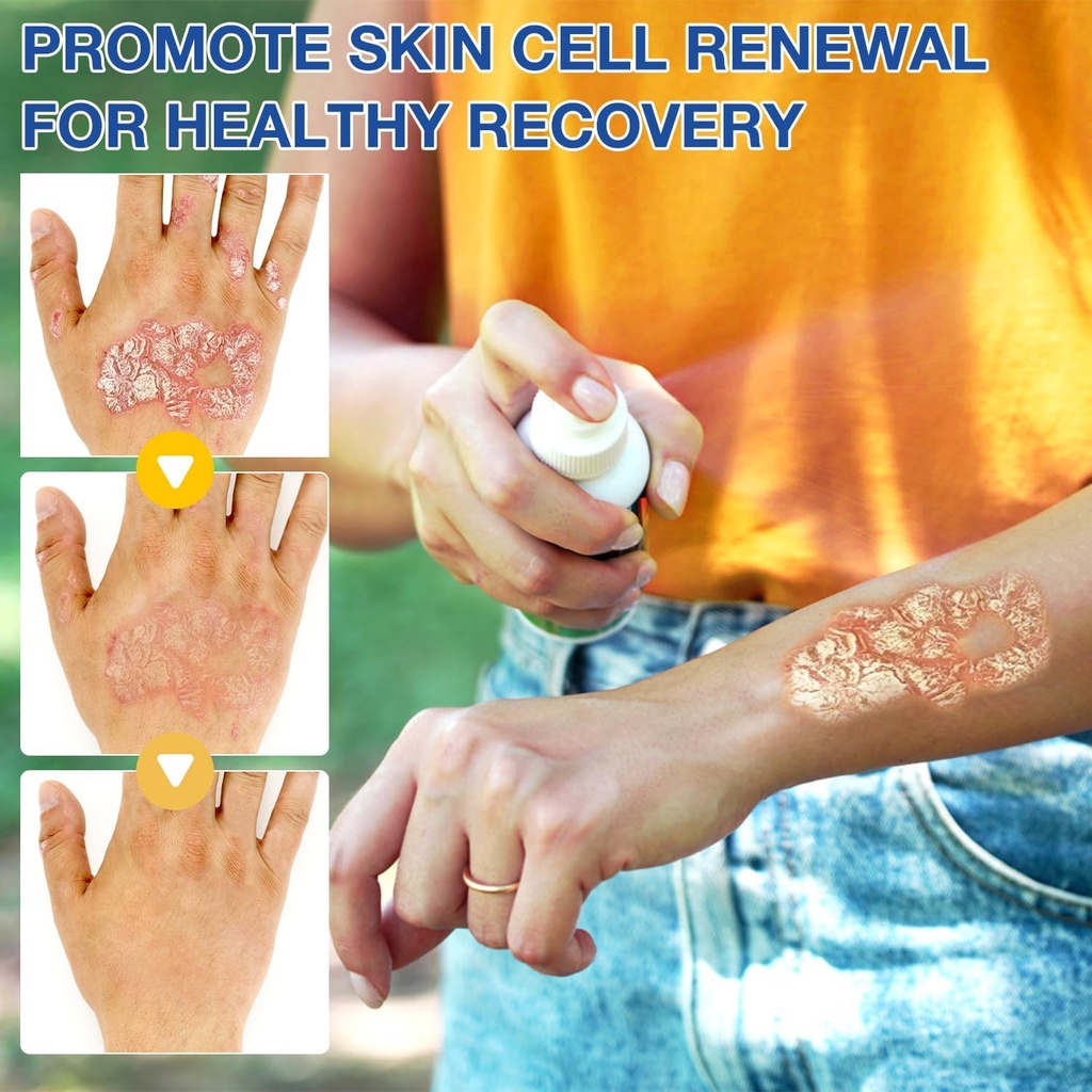 2-pcs-psoriaheal-bee-venom-psoriasis-tre-2.jpg