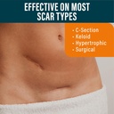 nuvadermis-silicone-scar-sheets---extra--4.jpg