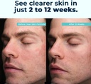 VitaMedica Clear Skin Vitamin Formula | Noncystic Acne Supplement for Skin Clearing | Breakout Treatment for Women and Men | Vitamins A, C, E, Selenium, Chromium, and Zinc for Skin Health | 2 Pack 4