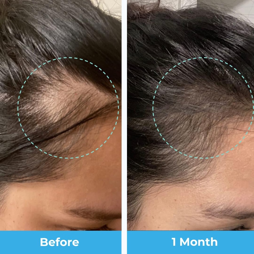 baby-blues-postpartum-hair-loss-vitamins-6.jpg