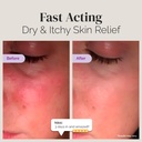 puriya-national-eczema-association-accep-3.jpg