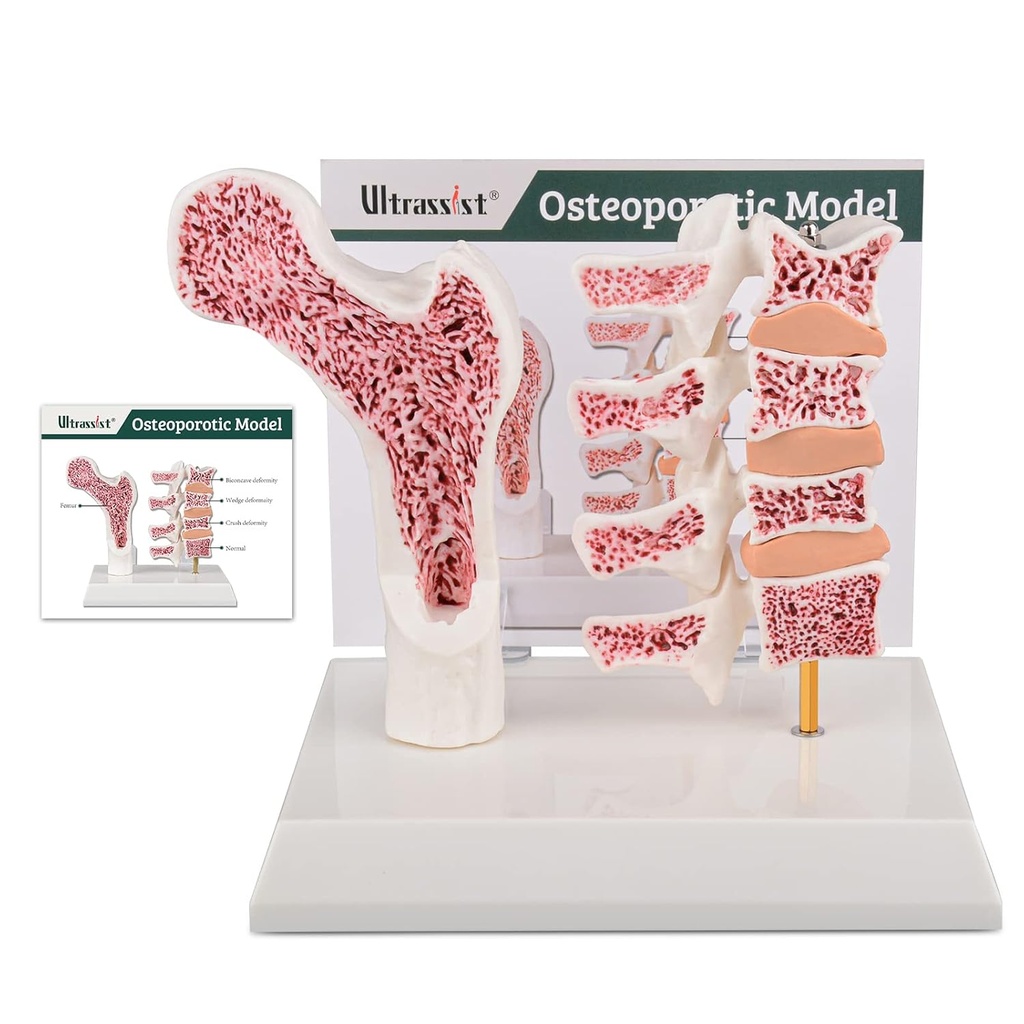 Ultrassist Human Anatomi Osteoporose Model, Vertebrae Anatomiske Skelet Model med studiekort for medicinsk studerende undervisning Demonstration